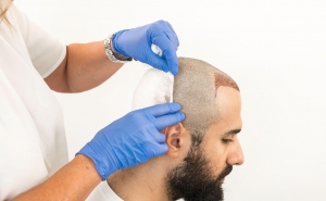 Nurturing Your New Growth: Essential Tips for Hair Care After a Hair Transplant