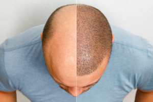 How Lifestyle Changes Complement Hair Transplant Results
