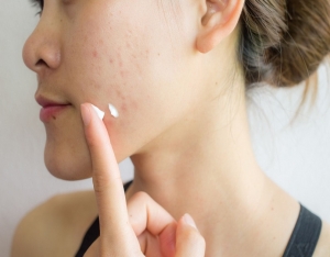 Where to Get Acne Treatment Dubai with Post-Care?