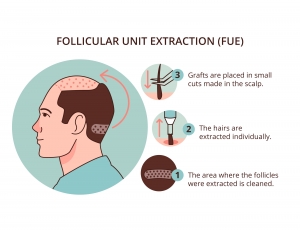 FUE Hair Transplants: Advanced Hair Restoration Procedure