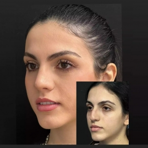 Revision Rhinoplasty in Islamabad: What to Expect