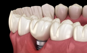 Are Dental Implant Infections Common?