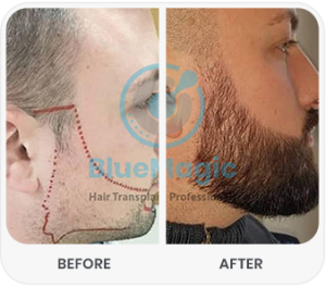 Beard Transplant in Turkey: Procedure, Duration, & What to Expect