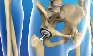 Understanding the Different Types of Hip Replacement