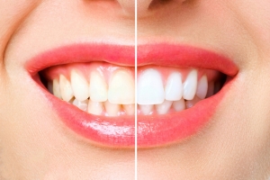 The Procedure of Teeth Whitening in Dubai