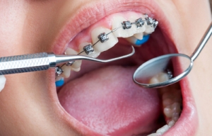 Common Orthodontic Treatments and Their Benefits