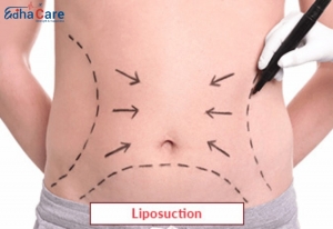 Liposuction Surgery in India – Procedure, Cost & Best Hospitals with EdhaCare