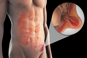 The Complex Hernia: What Does It Mean? How is it treated?