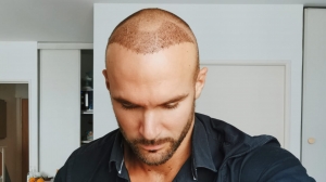 Does DHI Hair Transplant Work Better Than FUT?