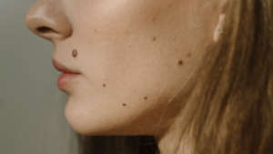 Mole Removal for Cosmetic vs. Medical Reasons: A Beverly Hills Guide