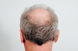 Could G Cell Hair Treatment Improve Crown Hair Thickness?