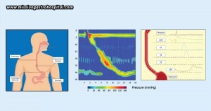 Oesophageal Manometry – What The Test Tells You About Your Swallowing Problem