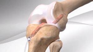 How are orthobiologics driving the Orthopedic Reconstruction Market?