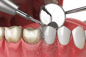 Understanding the Cost of Periodontal Dental Equipment: Factors to Consider