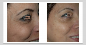 Botox Under Eyes Rejuvenation: Complete Explanation to Treatment, Benefits & Results