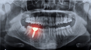 Common Questions About CBCT Dental Imaging Answered