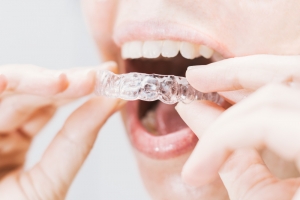 Expert Tips for SureSmile Aligner Aftercare and Hygiene