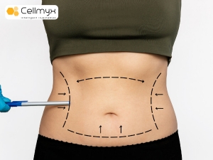 In and Out Liposuction – Quick, Effective Fat Removal