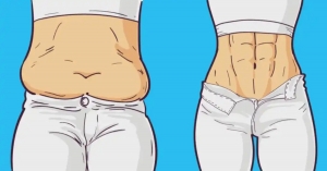 Liposuction VS Tummy Tuck: Which is the Best Choice for You?
