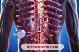 Intrathecal Baclofen Pump Treatment in India – Advanced Spasticity Management with EdhaCare