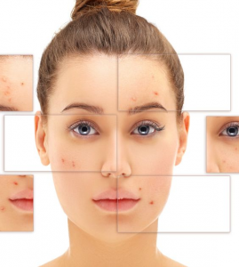 Laser Acne Treatment vs. Topical Creams: Which Works Faster?