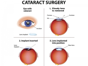 Why Choose Robotic Cataract Surgery in Noida for Clearer Vision