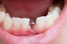 How Are Same-Day Dental Implants Different from Traditional Implants?