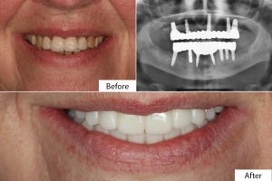 Can You Eat Normally After Dental Implant in Islamabad Surgery?