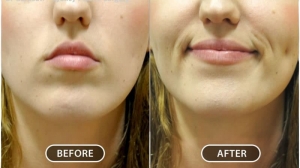 Expert Surgeons for Dimple Creation Surgery at Jaipur’s Trusted Hospital