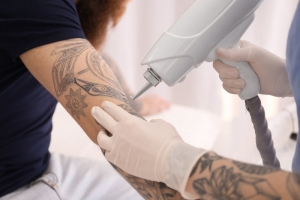 Success Stories: People Who Removed Tattoos in Islamabad