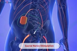 Sacral Nerve Stimulation Treatment in India – Advanced Bladder & Bowel Care with EdhaCare
