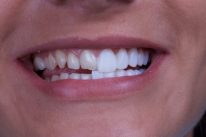How Much Do Dental Veneers Cost on Average?