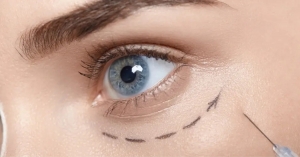 Botox Under Eyes Rejuvenation: Complete Explanation to Treatment, Benefits