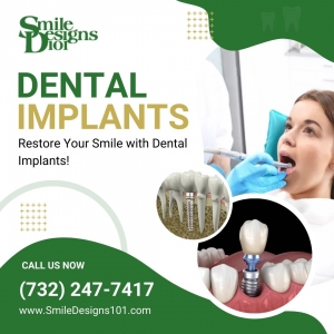 Are Same-Day Dental Implants Available in Somerset, NJ?