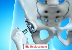 Hip Replacement Surgery in India | Cost, Procedure & Top Hospitals