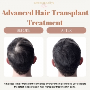 Advanced Hair Transplant Treatment at Derma Puritys for Natural Results.