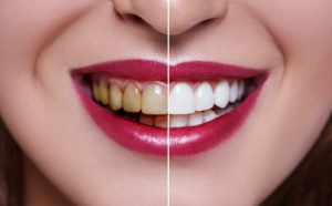 Is Teeth Whitening Effective for Teeth 