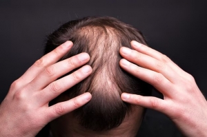 What Are the Most Effective Alopecia Treatments for Men Today?