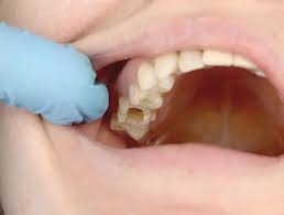 Is Wisdom Tooth Extraction Safe?