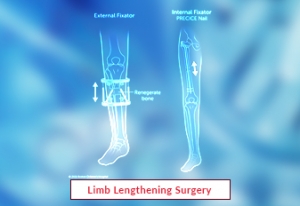Limb Lengthening Surgery in India with Edhacare
