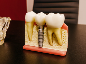 Choosing the Right Dentist for a Successful Dental Implant Surgery