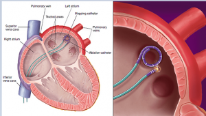 The Role of the LAAC Procedure in Stroke Prevention