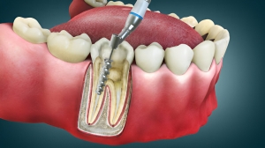 Understanding the Benefits of Root Canal Treatment in Farmington, NM