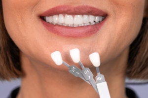 Why Are Porcelain Veneers in Miami Preferred for Natural Looking Results?