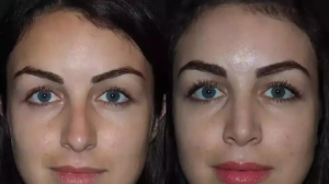 Best Rhinoplasty Surgeon in Dubai for Revision Nose Surgery