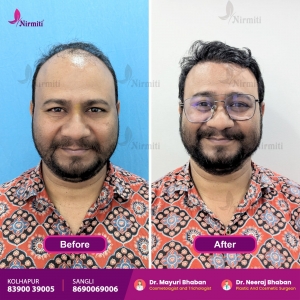 The Journey to Hair Restoration with the Best Hair Transplant Experts