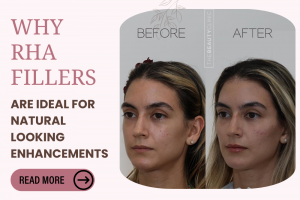 RHA Fillers