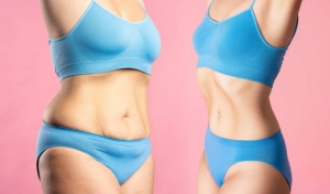 Liposuction Surgery in Riyadh Recovery Timeline: What to Expect Each Week