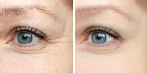Eyelid Surgery in India: Rejuvenate Your Look with Precision and Expertise