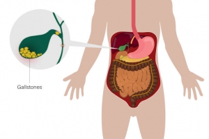 Gallstones Singapore: How to Choose the Right Specialist